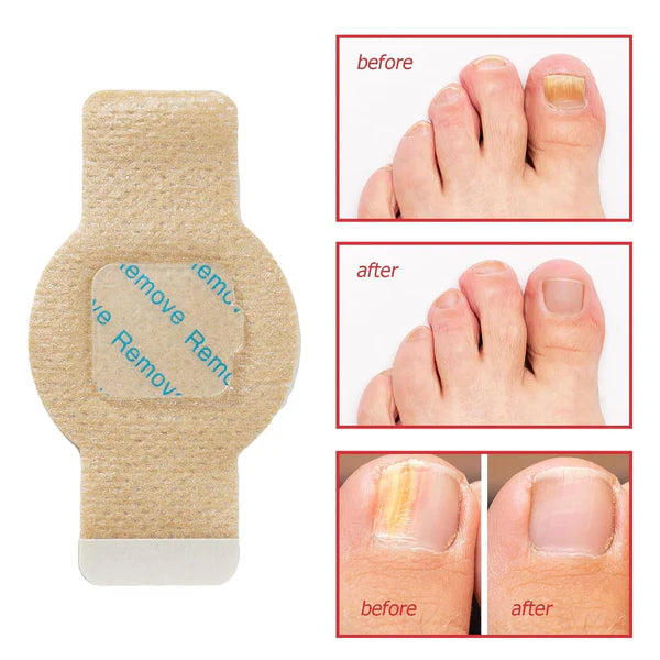 NailHeal™ - Fungal Nail Patches 🌿💅 ( Buy 1 Get 1 Free🔥🔥)